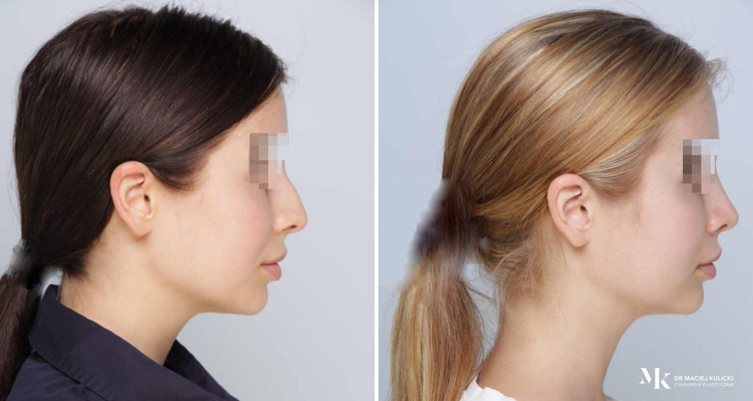 Korekcja Nosa • Rhinoplastyka • Chirurg Plastyczny Dr Maciej Kulicki 7946